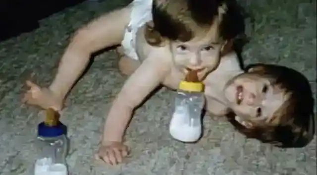 結合双生児としても特異