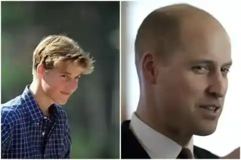 Prince William – Baldness