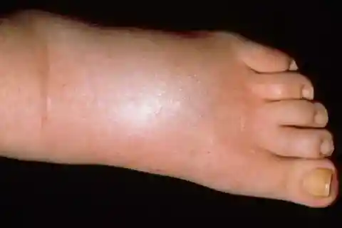 22. Persistent Leg and Foot Swelling