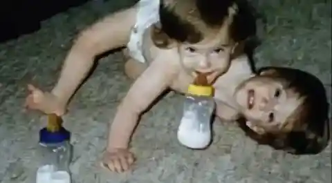 結合双生児としても特異