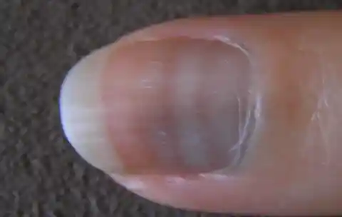 24. Changes in Nail Appearance